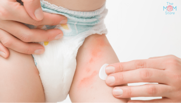 Best Home Remedies for Diaper Rash - The Mom Store