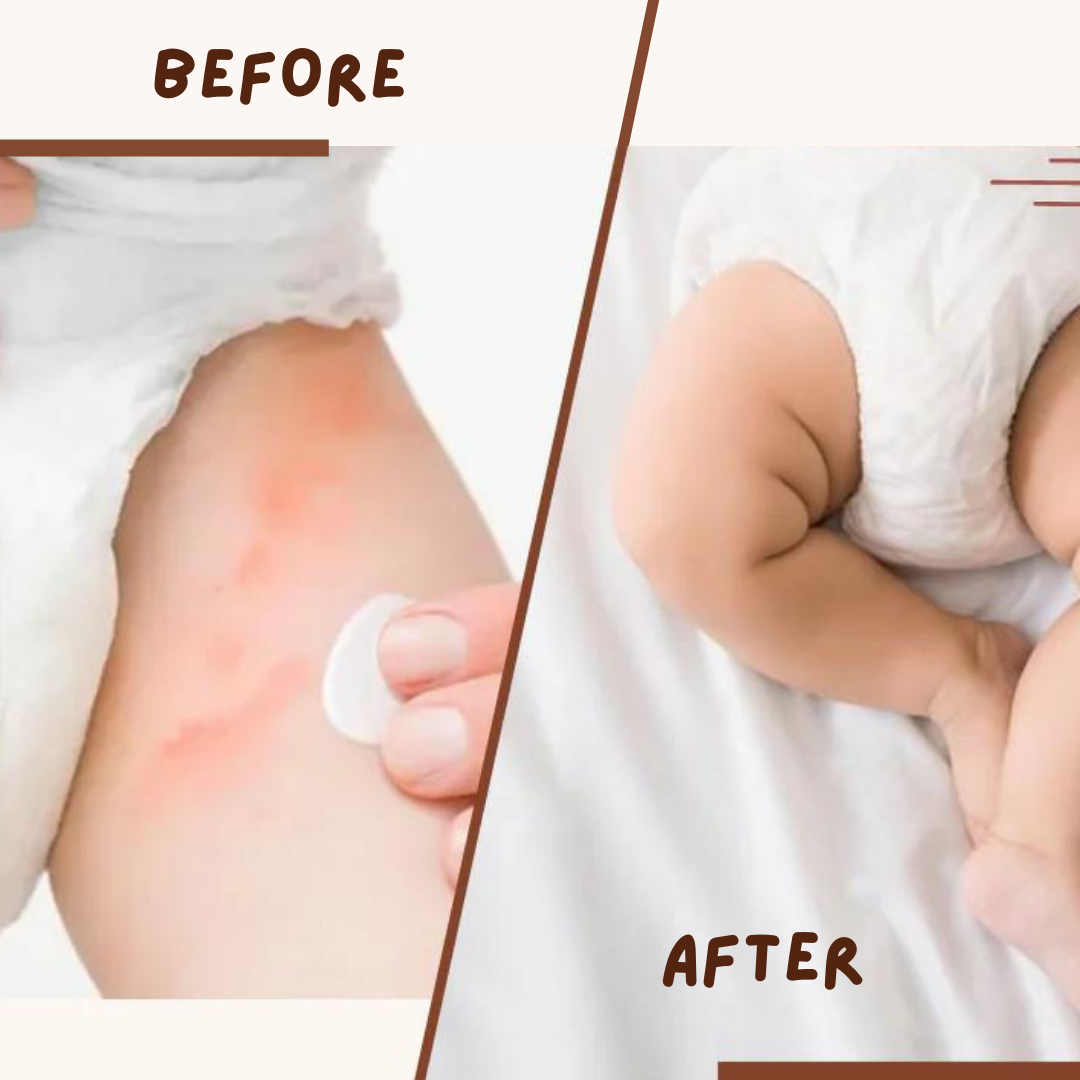 Coco Crush Rash Oil for Babies - Diaper & Nappy Rash Relief