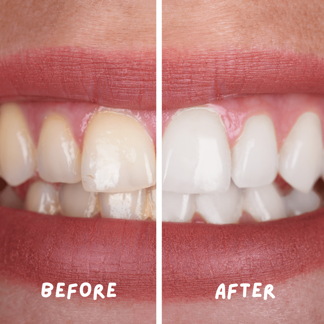 Coco Crush Ayurvedic Teeth Whitening Liquid | 100% Natural - TWHITE50