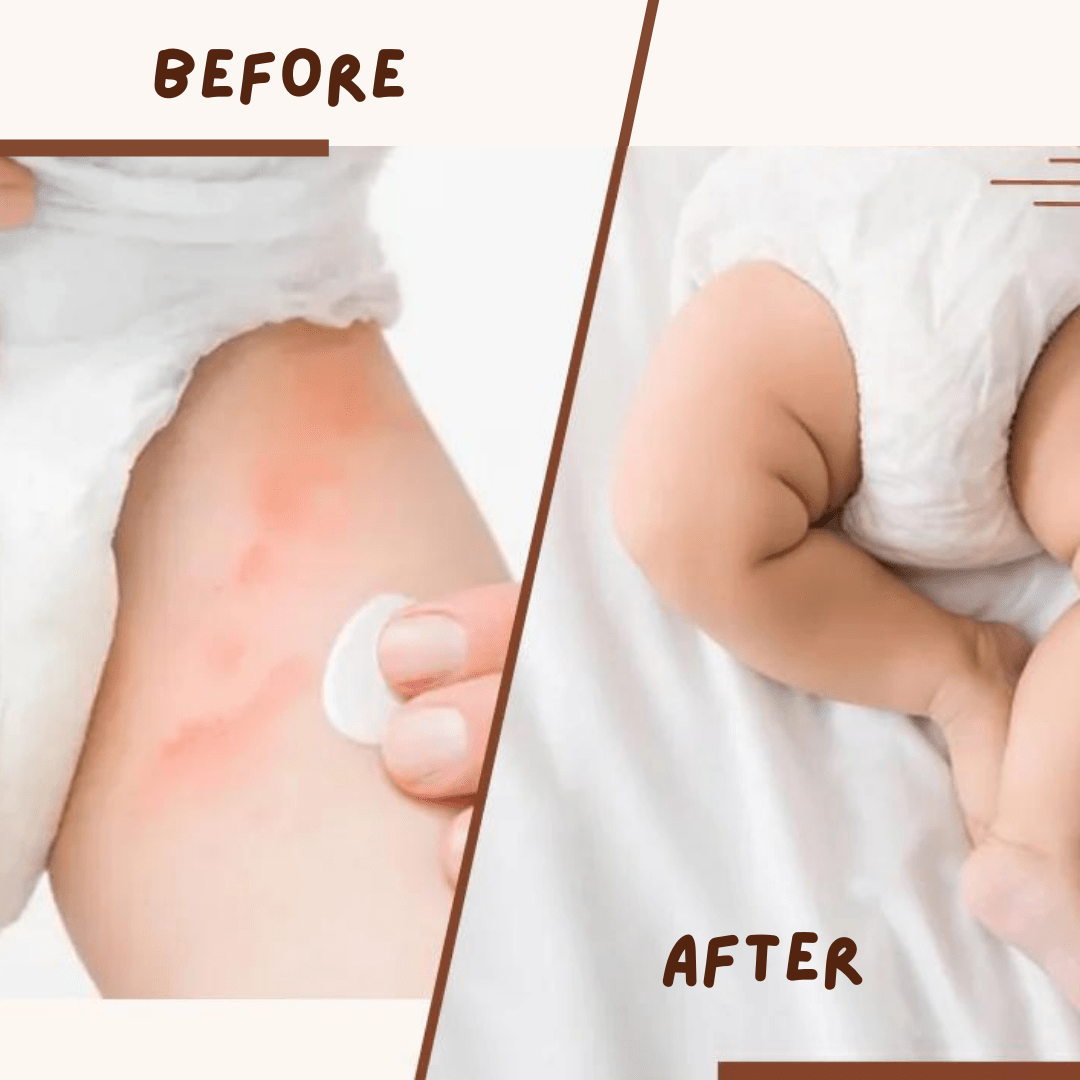 Coco Crush Rash Oil for Babies - Diaper & Nappy Rash Relief - RASHOIL100